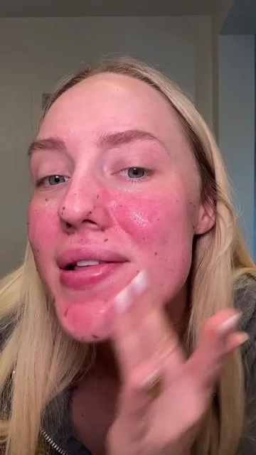 i do not play when it comes to my exfoliation routine & this has become my favorite product to use by farrrrr #melaxin #peelshot #melaxinpeelshot #exfoliation #blackhead 