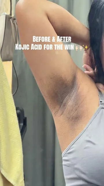 Pregnancy hormones mess up w/ my underarm. I am 4 weeks postpartum and in 1 week of using it i can really see the difference 🥹 @medicube global #niacinamide #vitaminc #underarmwhitening 