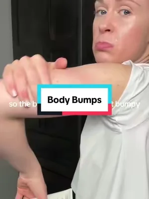 @Remedy Science to the rescue #bumpyarms #kp #dealsforyoudays #dermatologist #ad 