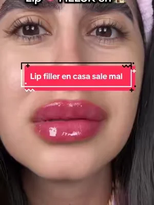 #lip #lips #melaxin #dealsforyoudays #lipbump 