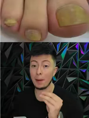 Me cansé de tener mis uñas amarillas por causa de lo hongos y ahora este antifungal no me puede faltar en mi casa! #antifungal #uñasamarillas #hongosenlasuñas #wellnesstips #dealsforyoudays 