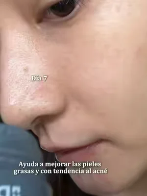 Es imposible eliminar los puntos negros #DealsForYouDays #skincare #blackhead #kbeauty #drleohonestreview 