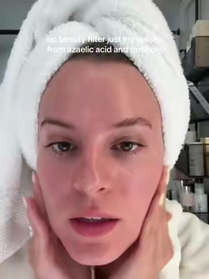 Literally my skin has never looked this good 