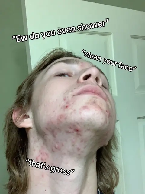 #medicube #acne #moisturizer #skincare #resultsmayvary 